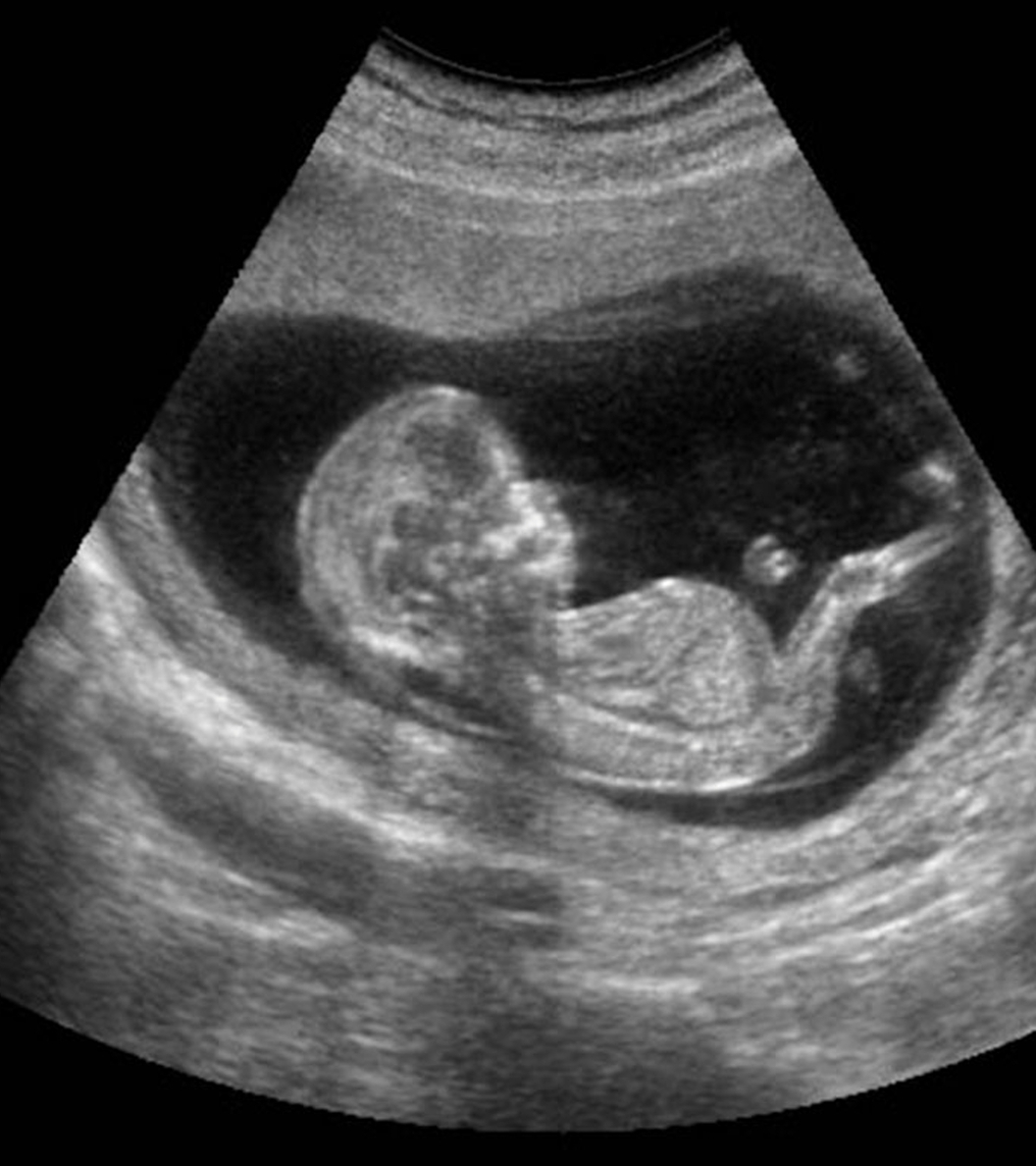 En la CDMX, Se aprobó el aborto, hasta los cinco meses de gestación
