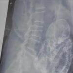 Encuentran un feto momificado en el vientre de una mujer de 84 años, en Durango