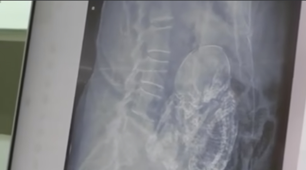 Lee más sobre el artículo Encuentran un feto momificado en el vientre de una mujer de 84 años, en Durango